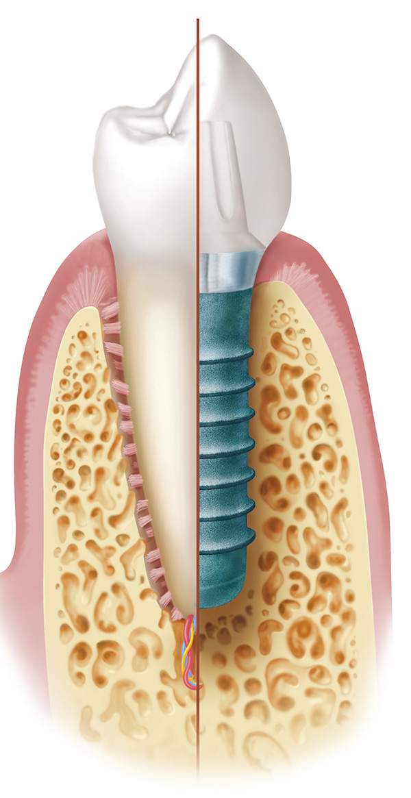 Implantate Wilhelmshaven 