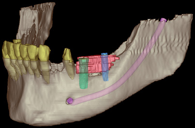 Implantate Wilhelmshaven: Digitale Volumentomographie 